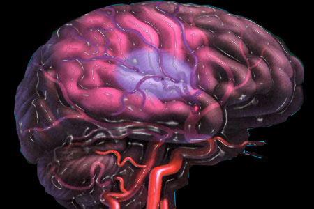 دکتر چیا پروتی قلات|متخصص جراحی مغز و اعصاب